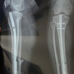 Maladies osseuses