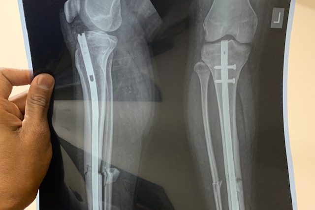 Maladies osseuses : examens essentiels pour un diagnostic fiable